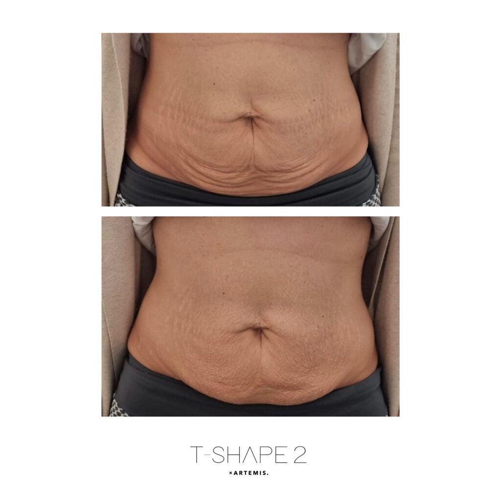 Abs_3