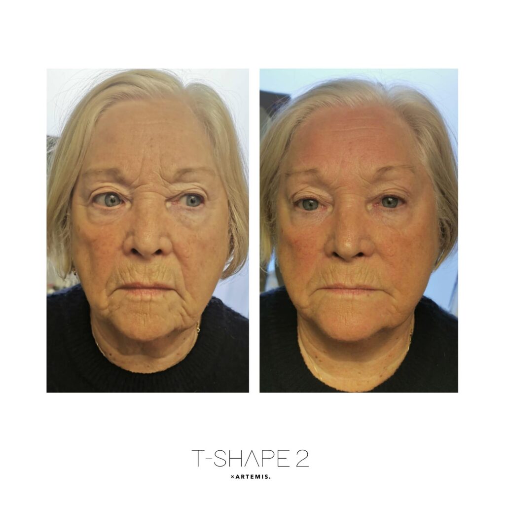 After 1 treatment