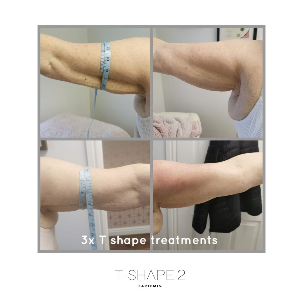 After 3 treatments
