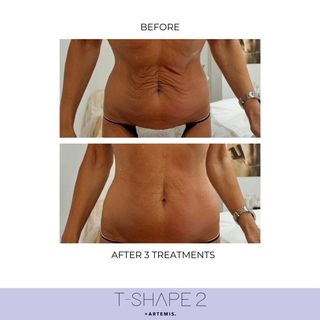 T2_3 treatments_Abdomen