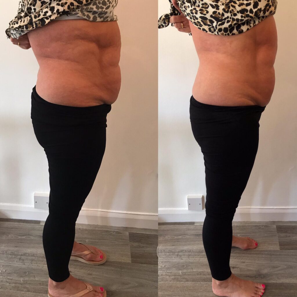 Tshape after 1 Fibrous fat
