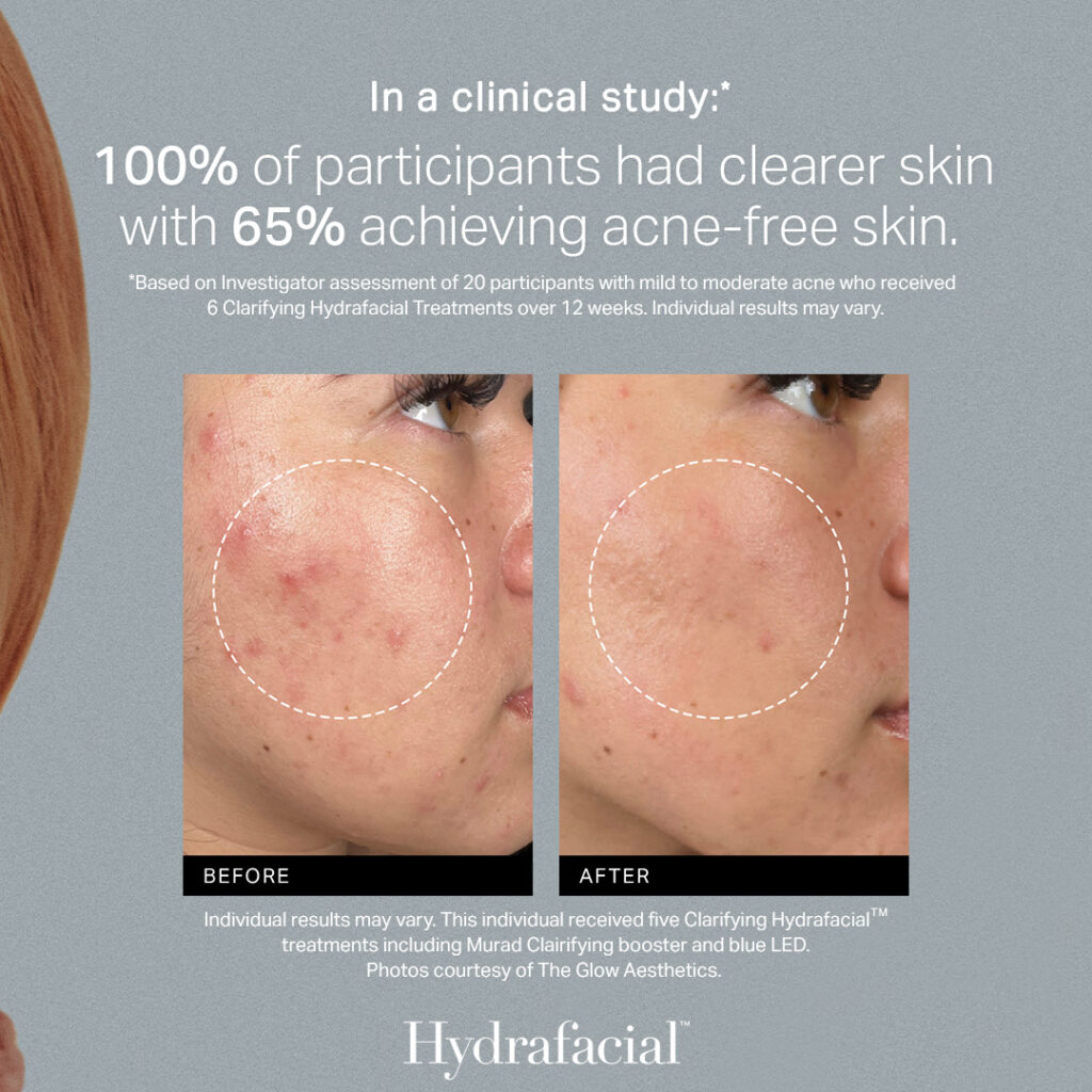 Acne TCH - Post 3 Feed Frame 3