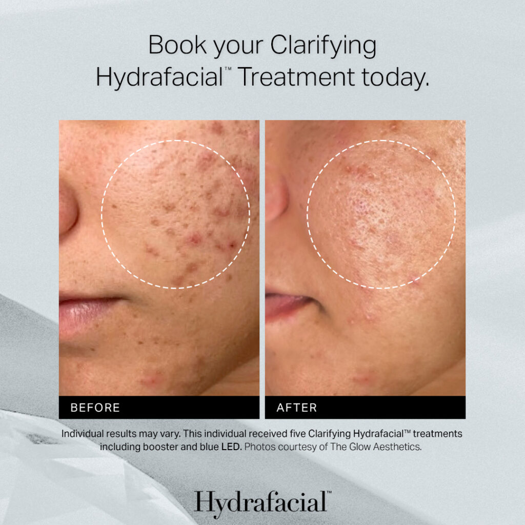Acne TCH - Post 4 Feed Frame 2