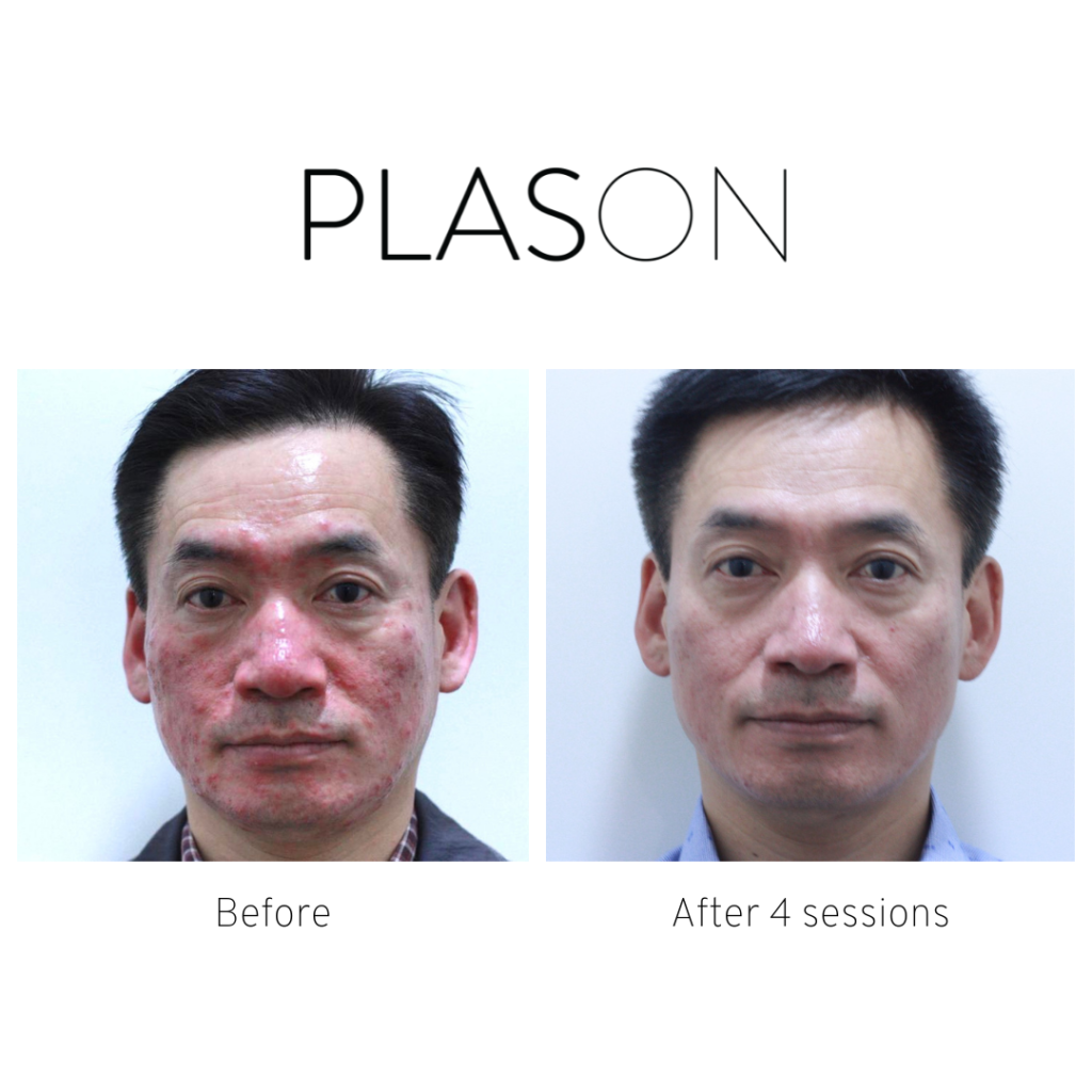 Male-B_A-4-sessions-front-1