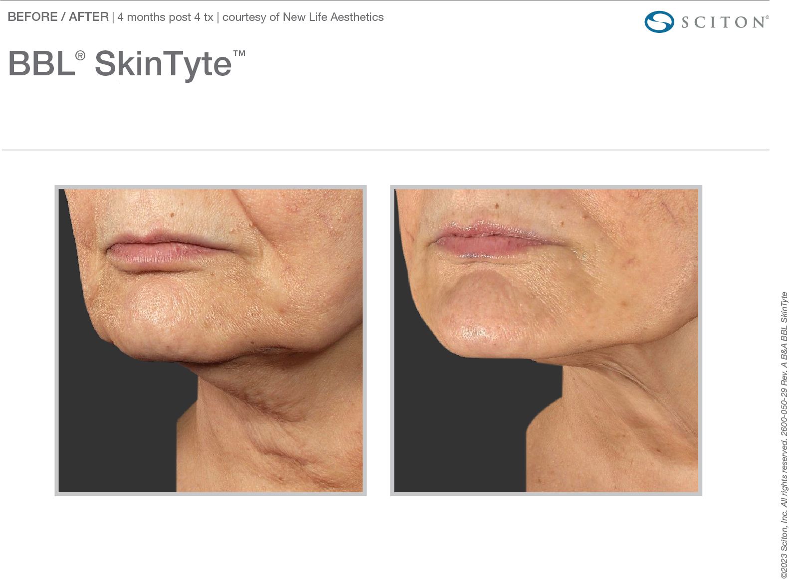 2600_050_29_Rev_A_B_A_Photos_BBL_Skin_Tyte_binder_7e25de8abb