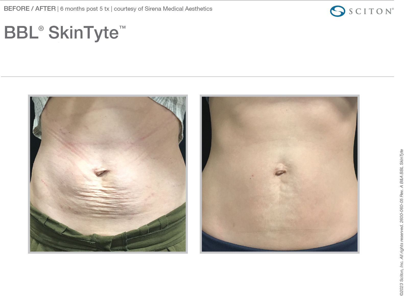 2600_060_05_Rev_A_B_A_Photos_BBL_Skin_Tyte_binder_1b26feed23