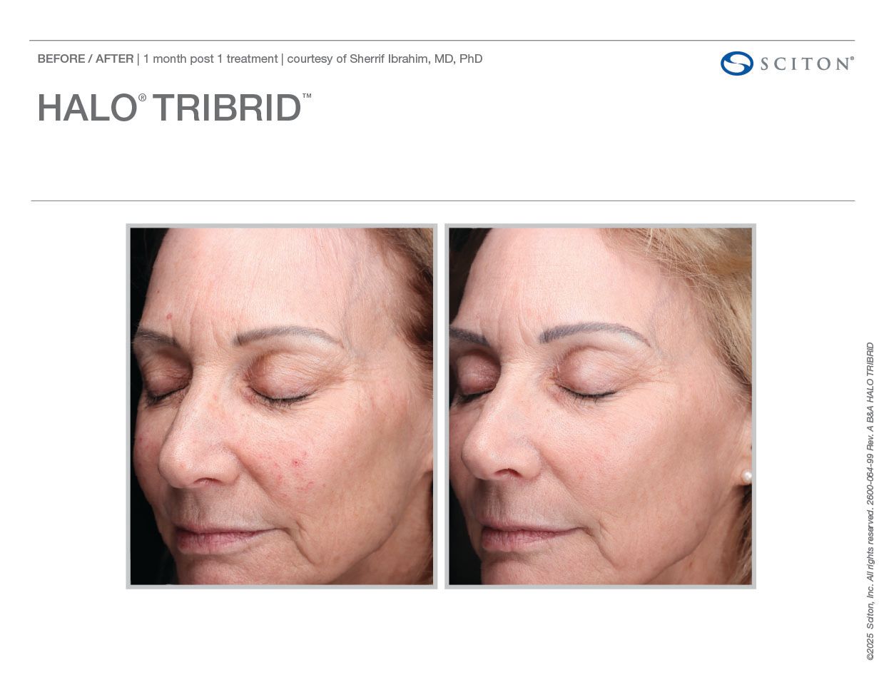 2600_064_99_Rev_A_B_A_Photos_HALO_TRIBRID_binder_2ae3741faf