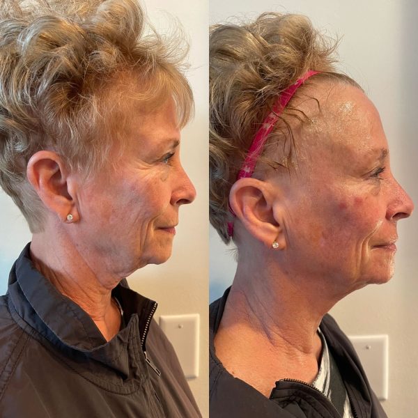 1 Facial + Coupler
