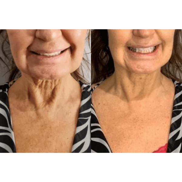 1-Facial