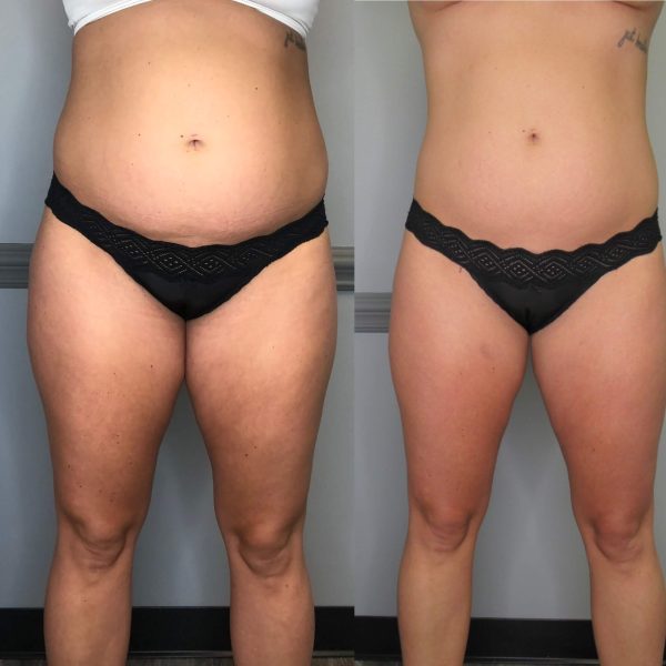 3-Shape-3-Tone-treatments-give-credit-to-@thrivecryostudio-1