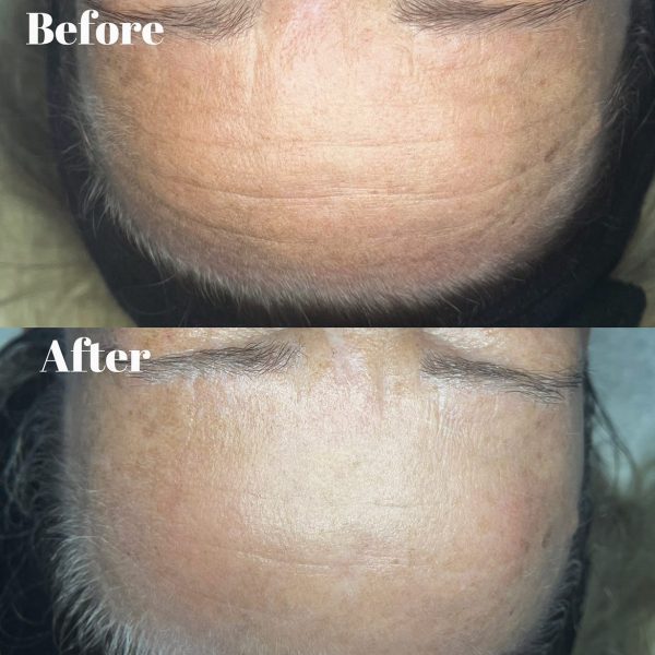@levirose, 1 facial treatment