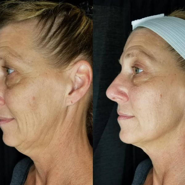 facial 3